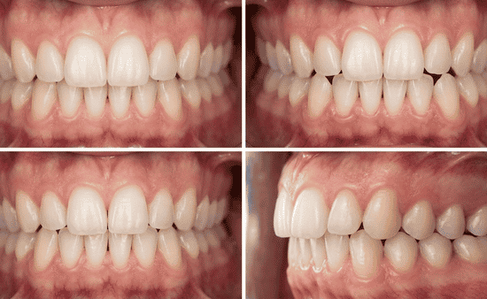 What Are Mild Bite Issues