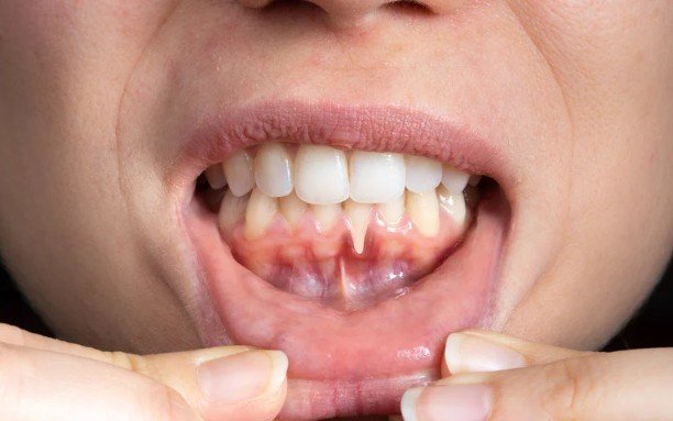 Red, Swollen, or Tender Gums